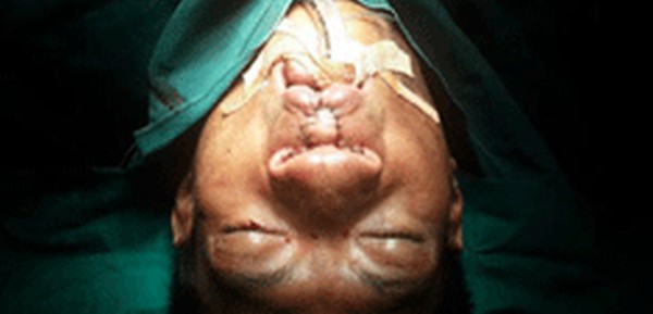 A patient undergoing cleft operation