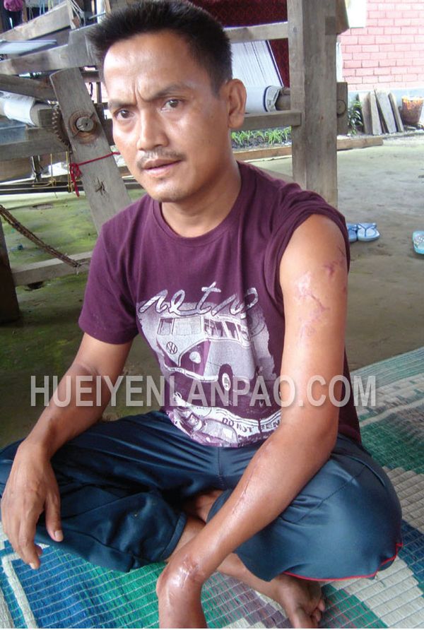 Injured ILP agitator seeks people's help for treatment