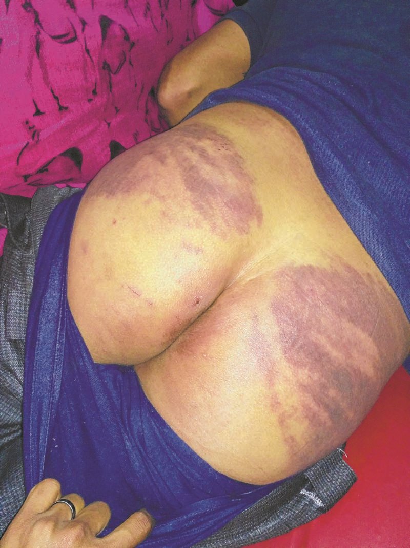 'Torture' victim recounts ordeal, flees home