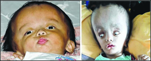 More Hydrocephalus cases discovered in the State, HELPIN to fly them to Fortis Hospital, New Delhi