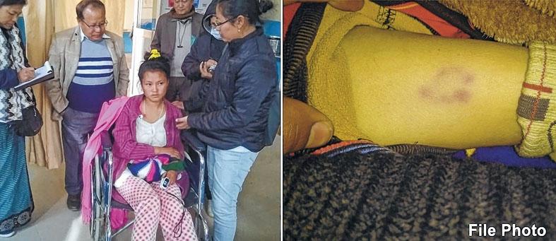 8 Scrub Typhus cases detected at Ukhrul village