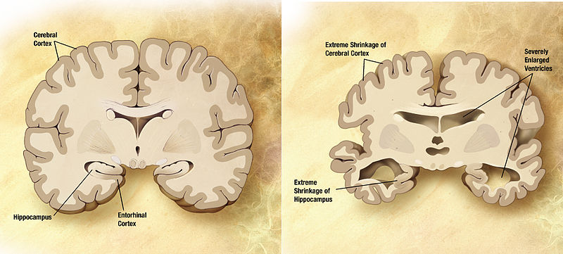 Combination of two brain diagrams in one for comparison. In the left normal brain, in the right brain of a person with Alzheimer's disease