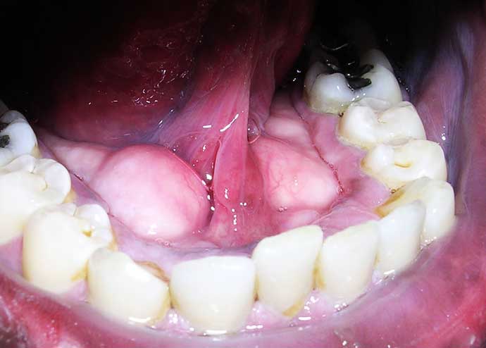 Inadequate removal of plaque caused a build up of calculus (dark yellow color) near the gums on almost all the teeth.