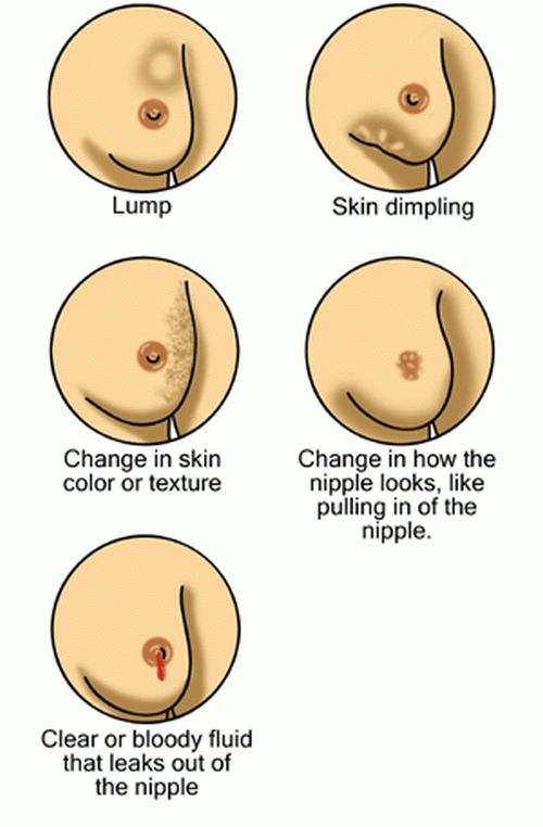 Early signs of breast cancer  