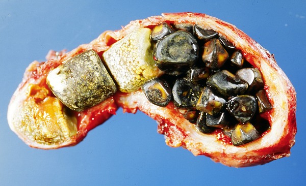 Opened gall bladder containing numerous gallstones