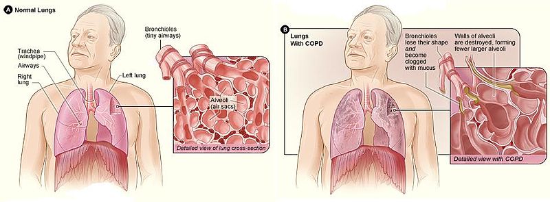 Figure A shows the location of the lungs and airways in the body. The inset image shows a detailed cross-section of the bronchioles and alveoli. Figure B shows lungs damaged by COPD. The inset image shows a detailed cross-section of the damaged bronchioles and alveolar walls