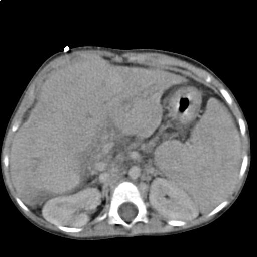 Abdominal computed tomography of a 3 year old child showing liver cirrhosis in transverse section
