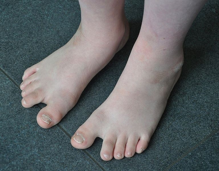 Feet of a 10 year old boy with Down Syndrome, with the typical large space between the large toe and second toe 
