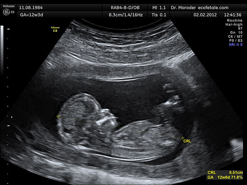 Ultrasound image of the foetus at 12 weeks of pregnancy in a sagittal scan. Measurements of fetal Crown Rump Lenght (CRL).