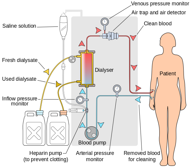  Hemodialysis schematic : Simplified hemodialysis circuit