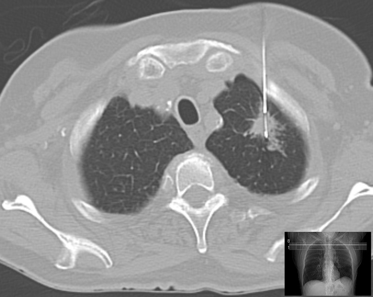 Lung biopsy guided by computertomography: Lung cancer.