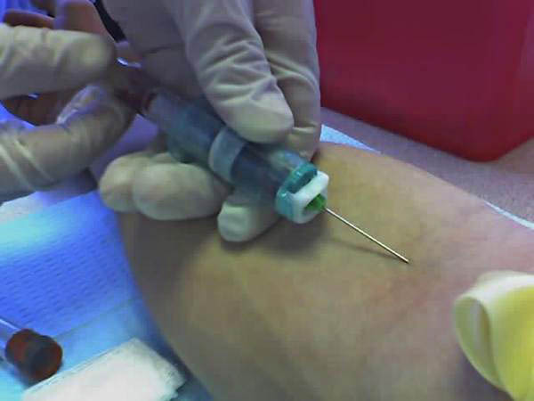 Venipuncture using a vacutainer 