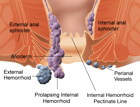 Types of hemorrhoids