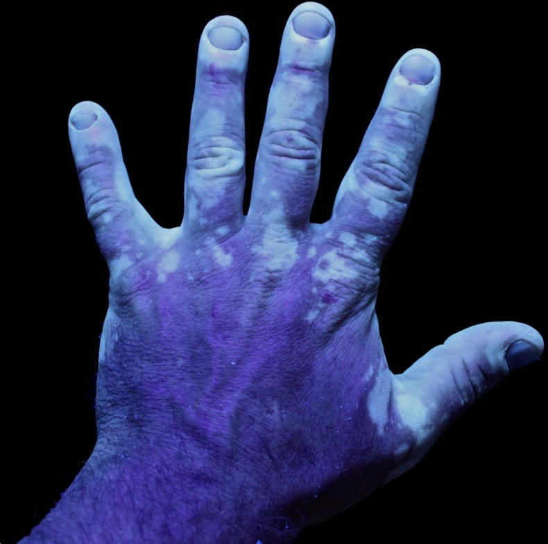 UV photograph of a hand with vitiligo 