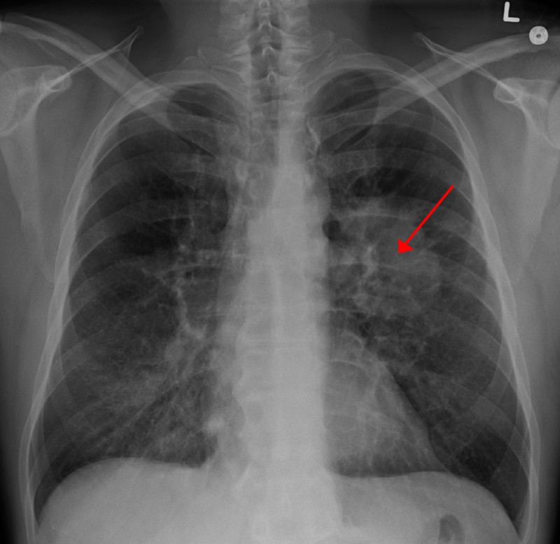 Lung CA seen on CXR