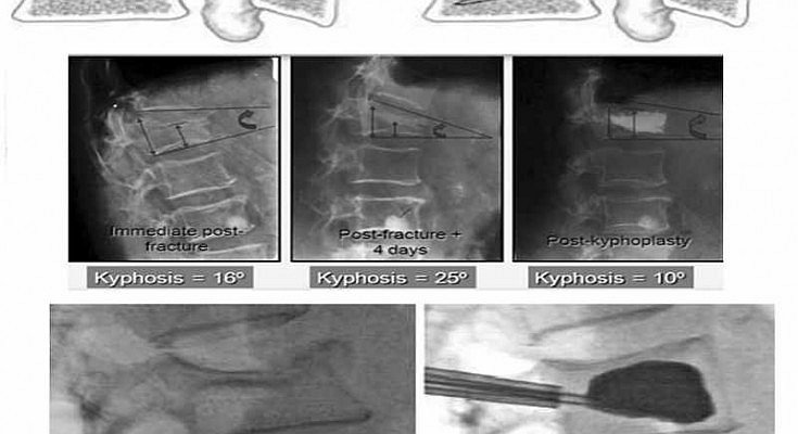 Balloon Kyphoplasty in Osteoporotic spinal fractures