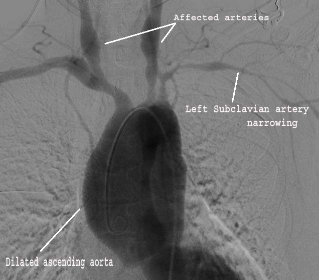  Digital Subtraction Angiogram (DSA) for diagnosis of Takayasu Arteritis 