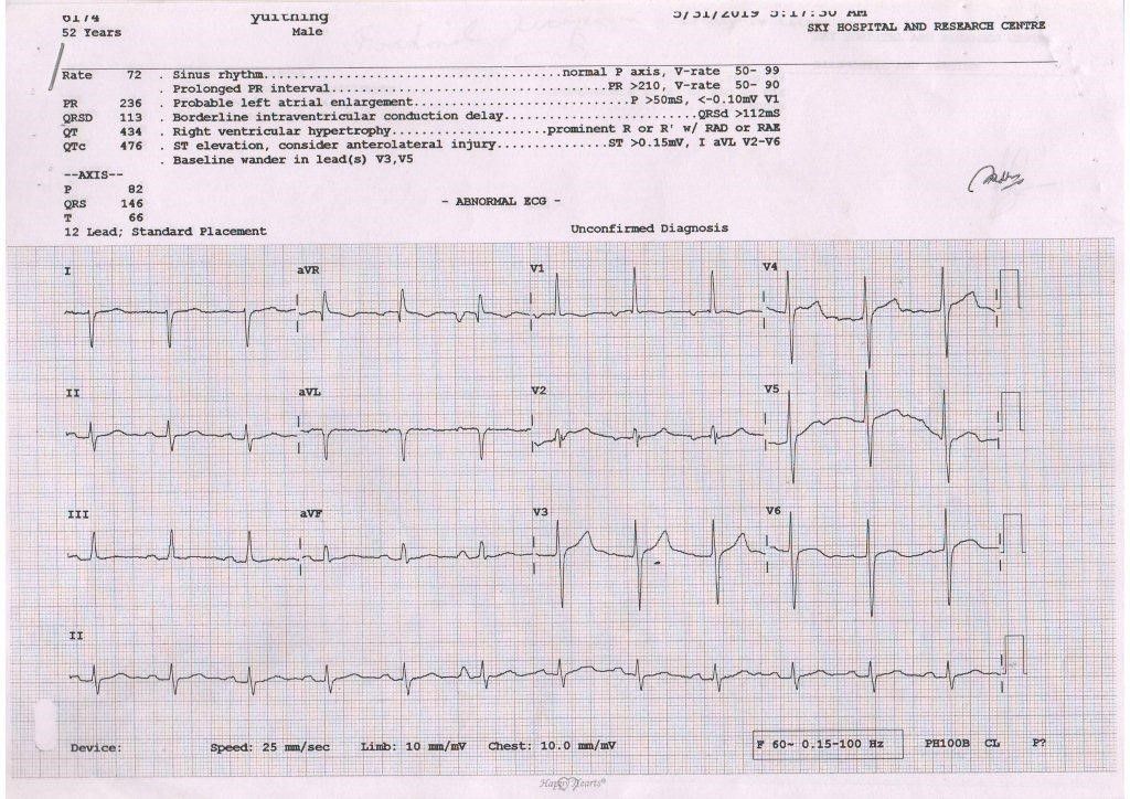 (normal heart beat rhythm) (Fig-3) 