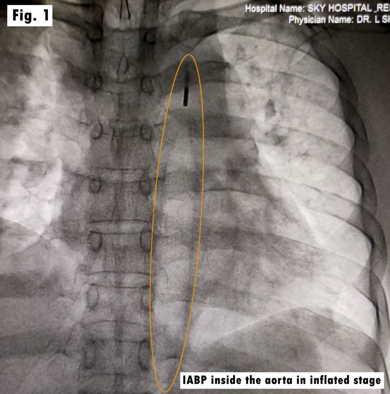  inflation and deflation of the intra-aortic balloon 