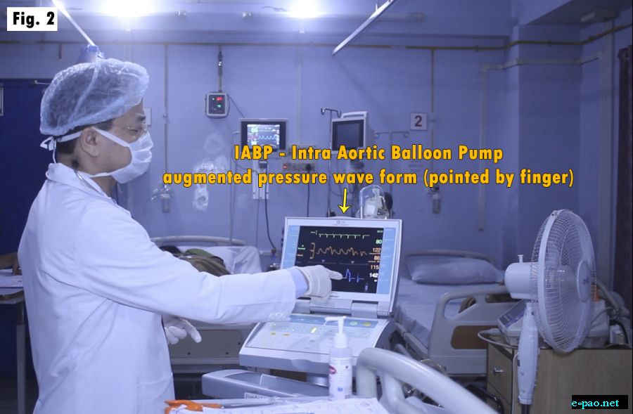  inflation and deflation of the intra-aortic balloon with the pump 