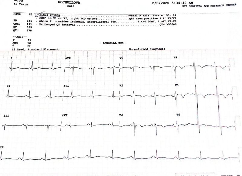  Atrial Flutter treated with Radio Frequency Ablation  