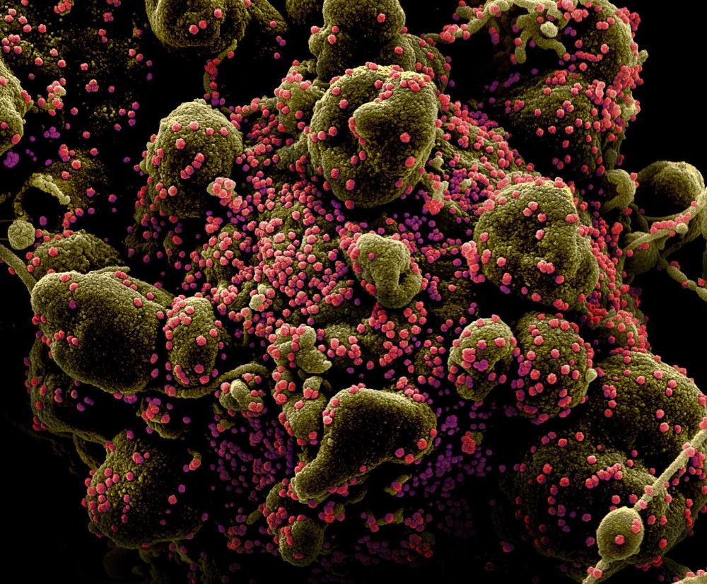  Colorized scanning electron micrograph of an apoptotic cell (greenish-brown) heavily infected with Covid-19 virus particles (pink) isolated from a patient sample 