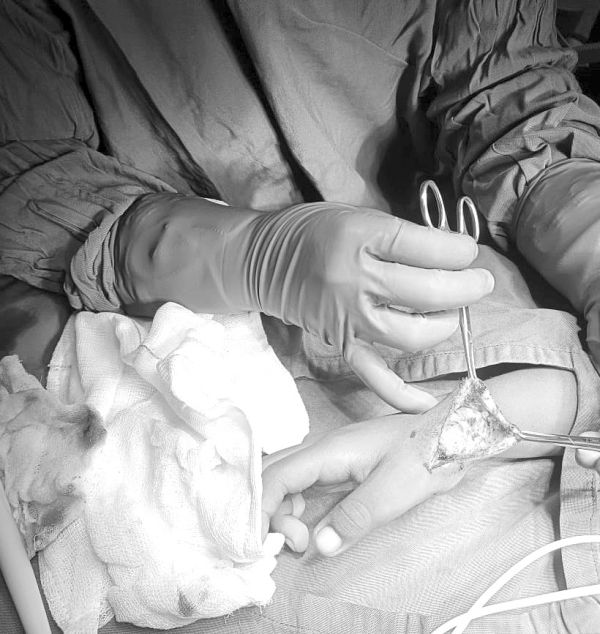 BABINA Hospital performs rare vascular surgery on 8 years old boy