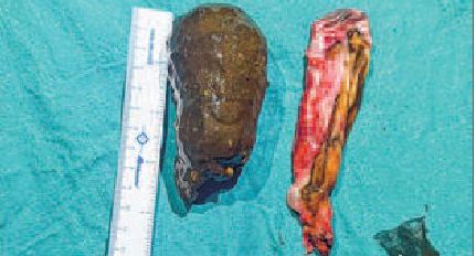 9 cm gallstone removed at Little Clinic